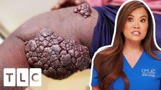 Dr. Lee Is STUMPED By Large Clustered Leg Lumps  Dr. Pimple Popper