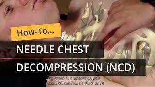 Needle Chest Decompression in TCCC