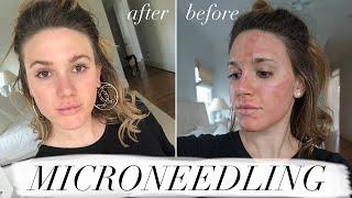 MY FIRST MICRONEEDLING EXPERIENCE & WHAT TO EXPECT ACNE SCAR TREATMENT