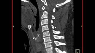 Cervical Spine Trauma