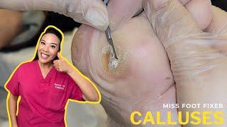 How To Remove Calluses From Feet Quickly & Safely Effective Home Treatment  Miss Foot Fixer