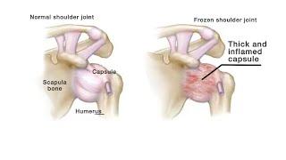 Mayo Clinic Minute Tips to help a frozen shoulder