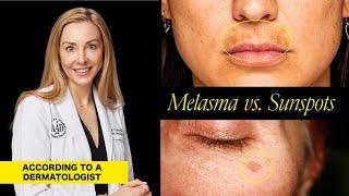 Understanding Melasma and Sunspots Key Differences Causes and Treatment Options