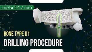 Drilling procedure for XGate Dental X11 and X3 Pure&Porous Implant 4.2 mm diameter bone type D1
