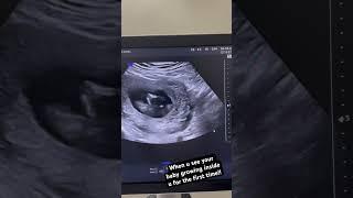 14 weeks baby growing inside the womb #baby #gynaecologist #ultrasound #pregnancyultrasound