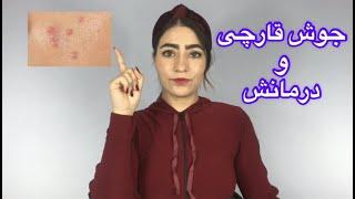 جوش صورت را چگونه از بین ببریم؟درمان جوش قارچی