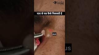 घाव से पस कैसे निकलती है  Pus discharge from wound #shorts