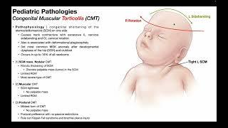 Torticollis → Mechanism Pathophysiology & Effects in Infants