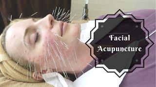 Facial Acupuncture  Korean Beauty Secret