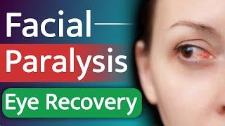 Facial Paralysis Eye Recovery  Eye Recovery After Bells Palsy  Bells Palsy Patient  SRIAAS