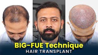 Hair Transplant in Kochi  Cost of Hair Transplant in Kochi  Hair Transplant Doctor in Kochi