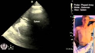 Abdominal Ultrasound of the Spleen Basic Video