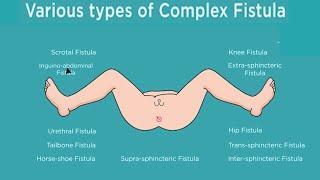 Anal Fistula Can Be Cured With DLPL. Everything You Need To Know From India’s Top Fistula Expert