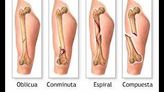 Rehabilitacion Fractura de femur