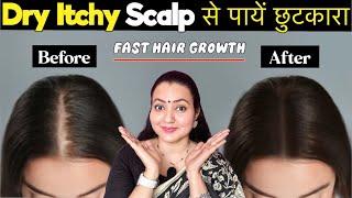 Dry Scalp Treatment At Home  Itchy Flaky Scalp से पाएं छुटकारा और पाएं Fast Hair Growth 