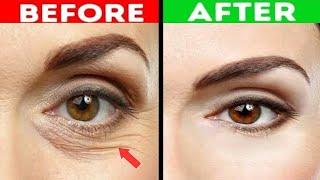 Reasons and Treatment Of wrinkle and Fine lines under the eyes Dr.Vivek Joshi