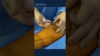 Kneecap patella button loosens after total #kneereplacement #kneeinjury #fracture