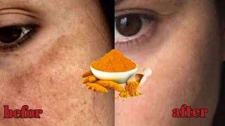 The secret of treating blemishes and freckles on the face - The easiest way to remove blemishes