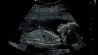 18 week ultrasound bouncing baby