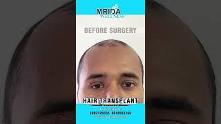 Time to Shine The Journey of Hair Regrowth  Witness the Wonders of 6 Months Hair Transplant Growth