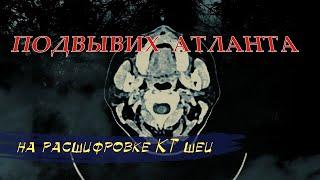 Головокружение и БОЛЬ В ШЕЙНОМ ОТДЕЛЕ позвоночника при ПОДВЫВИХЕ АТЛАНТА на расшифровке КТ шеи