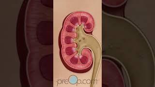 PreOp®  Advanced Techniques in Kidney Stone Removal #preop #shorts #health 