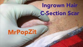 C-Section scar ingrown hair removed. Wait for it. Inflammatory nodule drained with 2 blackheads.