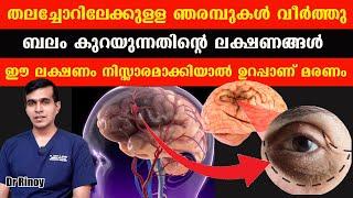 തലച്ചോറിലേക്കുള്ള ഞരമ്പുകൾ വീർത്തു ബലം കുറയുന്നതിന്റെ ലക്ഷണങ്ങൾ .ഈ ലക്ഷണം നിസ്സാരമാക്കിയാൽ Dr Rinoy