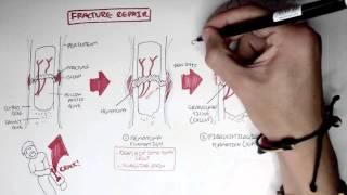 Bone Fracture - Types Fracture Repair and Osteomyelitis