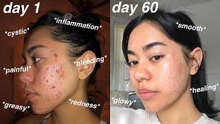 I CLEARED MY ACNE *60 days using Differin Gel Adapalene 0.1% + pictures*