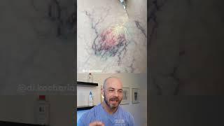 Dermatologist reacts to super satisfying vein therapy #dermreacts #doctorreacts #veintherapy