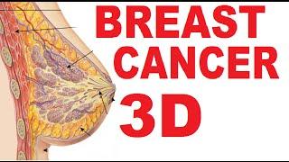 Breast Cancer - Lump Symptoms Mastectomy Mammogram - Breasts #3