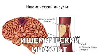 Ишемический инсульт