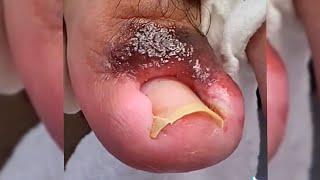 INFECTED Overgrown Toenail REMOVAL ***Toe Meat ***
