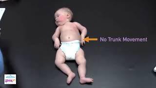 Learn to Spot the Warning Signs of SMA – Squirming? Video 7