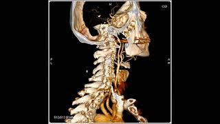 CTA Carotid Arteries