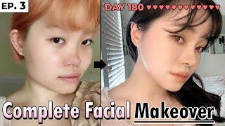 SUB Full Facial Plastic Surgery After 6 months in South Korea  REAL before and after REVIEW