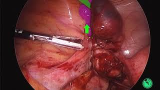 Laparoscopic Salpingectomy Tubal Ectopic Pregnancy by Migs_Tips