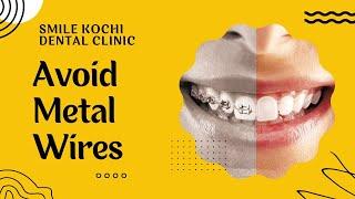 Metal-Free Transparent Aligners at Smile Kochi Dental Clinic  Kadavanthara  Palarivattom