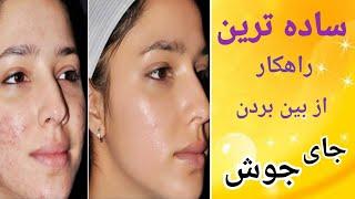 بهترین روش ازبین بردن جای جوش با ساده ترین مواد - treatment of boil at home