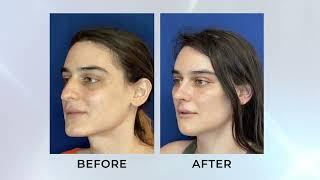 Facial Feminization Surgery with Dr. Pang  Align Surgical Associates