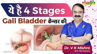 ये है 4 Stages Gall Blabber कैंसर की  GALL BLADDER CANCER HOW TO DIAGNOSE