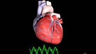 What is Ventricular Tachycardia