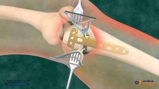 High Tibial Osteotomy HTO for Bow Leg Correction