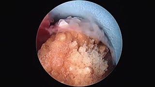 दूरबीन द्वारा गुर्दे की पथरी का ऑपरेशन  Kidney Stone Removal  PCNL keyhole technique for stone