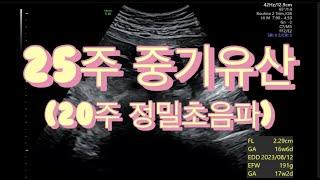 25주 중기유산ㅣ20주 정밀초음파ㅣ뇌량무형성증ㅣ성장지연ㅣ양수과소증ㅣ태반부전