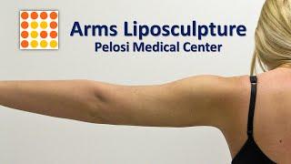 Arms Liposculpture High Definition Liposuction at PMC