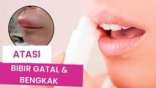 Bibir Gatal dan Bengkak? Begini Cara Mengatasinya