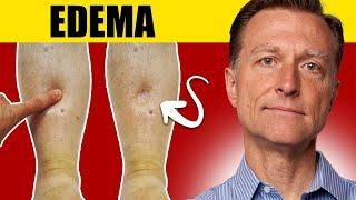 8 Surprising Causes of Edema Uncover the Truth