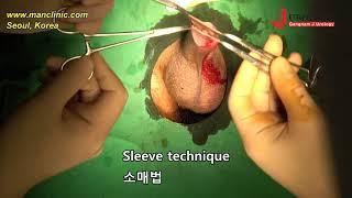 Sleeve technique Circumcision Ⅱ  소매법 포경수술 Ⅱ
